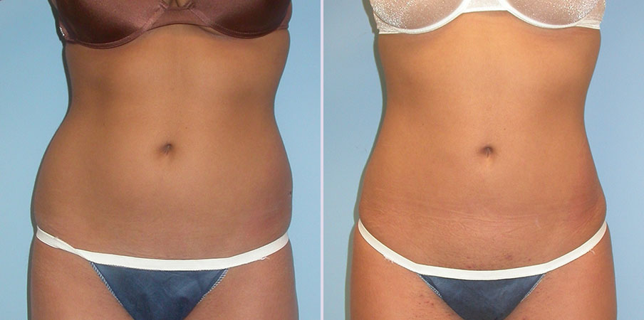 liposuction stomach hips and flanks front