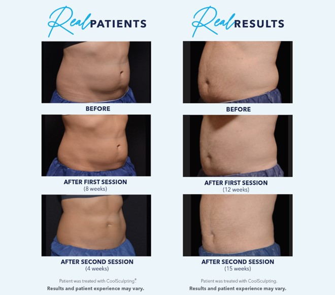 What is CoolSculpting®?, CoolSculpting